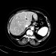 Hepatopathy after chemotherapy: CT - Computed tomography